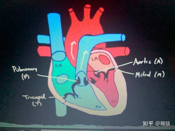 三尖瓣和二尖瓣突然关闭,会产生噪音,产生心音一(s1) 而肺动脉瓣与主