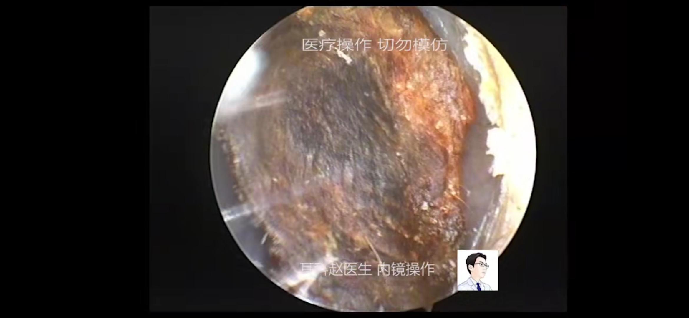 看到第一张图大家对耵聍栓塞有初步的直观感受了把.别急!