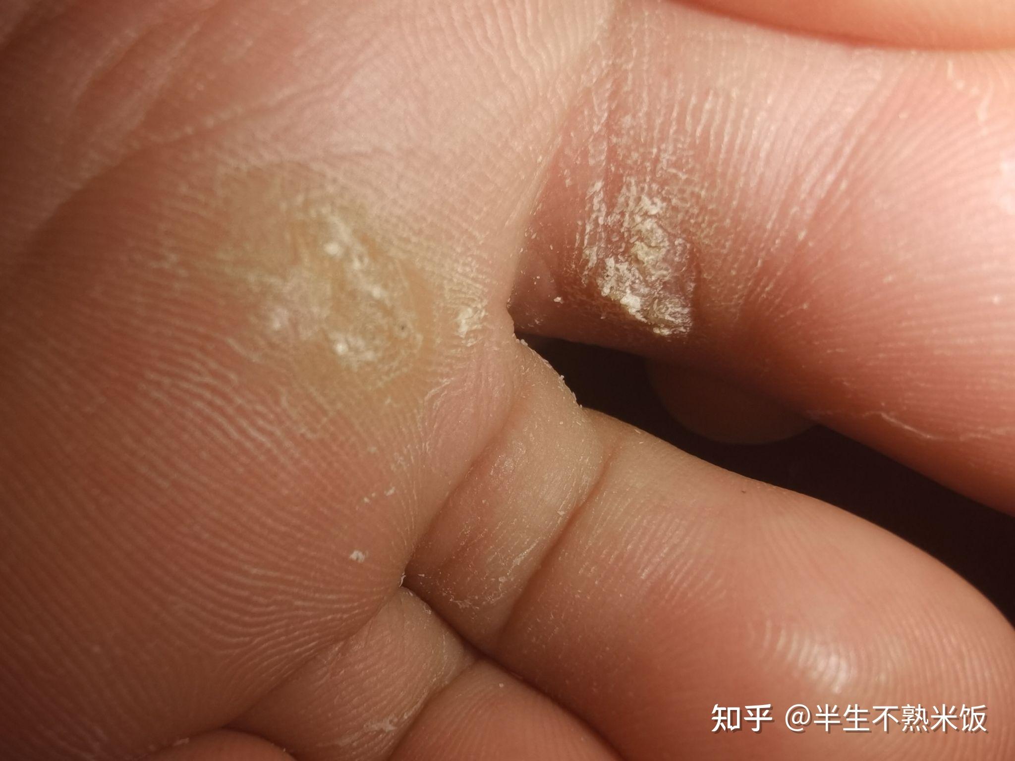 两年的治疗跖疣记录持续更新