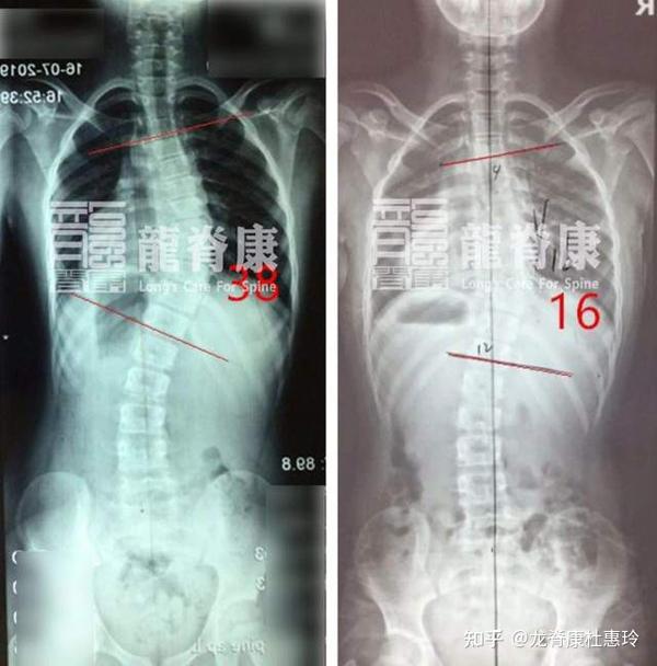 9岁女孩脊柱侧弯38半年内减至16