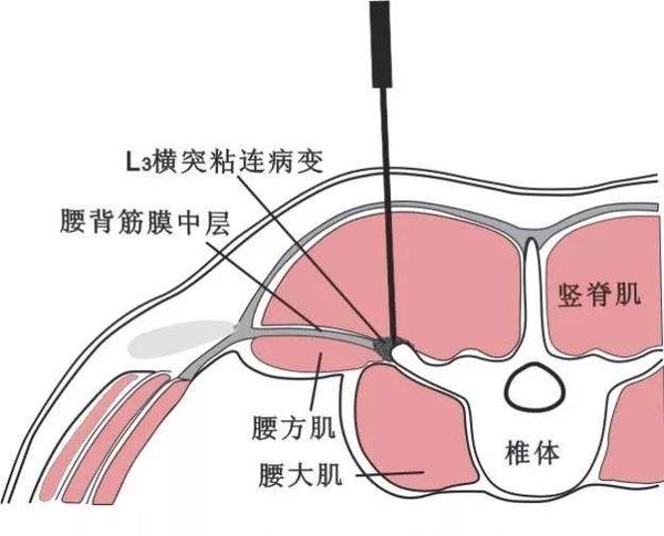 可能是"腰3横突综合症"