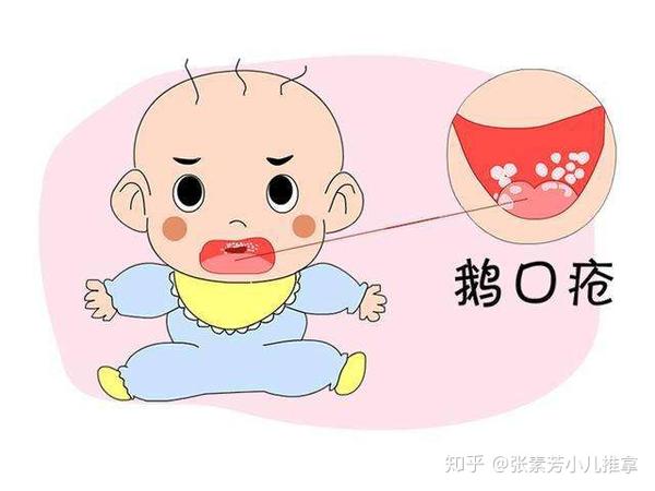 张素芳小儿推拿李波:鹅口疮和奶垢的区别宝妈们可别弄混淆了