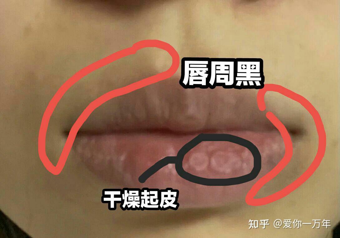 唇周黑如何解决