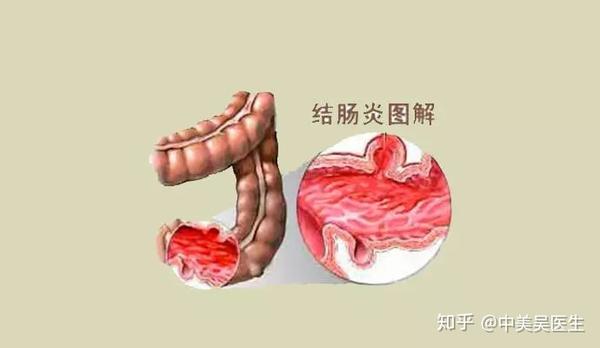 被诊断为溃疡性结肠炎,这是一种什么病?