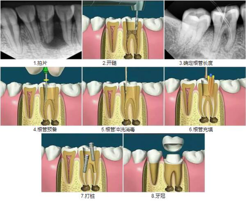 其实简单来说根管治疗的过程从 根充预备-根管消毒-根管… 阅读全文
