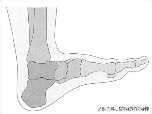 扁平足:扁平足就是人脚上的舟状骨,比正常人多长出一小块,拖到脚底下