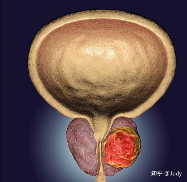 做前列腺癌筛查你不得不知道的