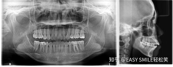 口腔曲面断层片可以得知是否有龋齿,补牙,阻生齿等牙齿健康问题,以及