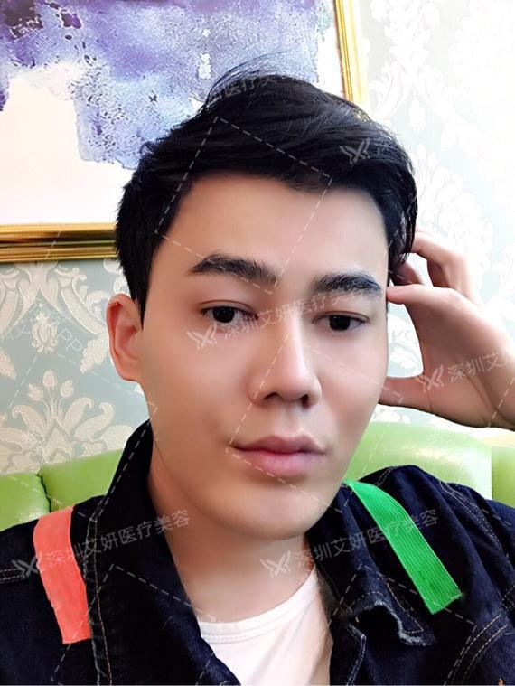 宽鼻案例2一个被宽鼻毁掉的大帅哥看他如何改变