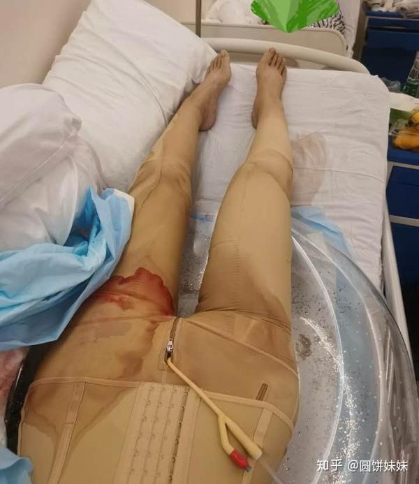 成都大腿吸脂,吸脂疼吗?为什么理解不了吸脂的人,术后
