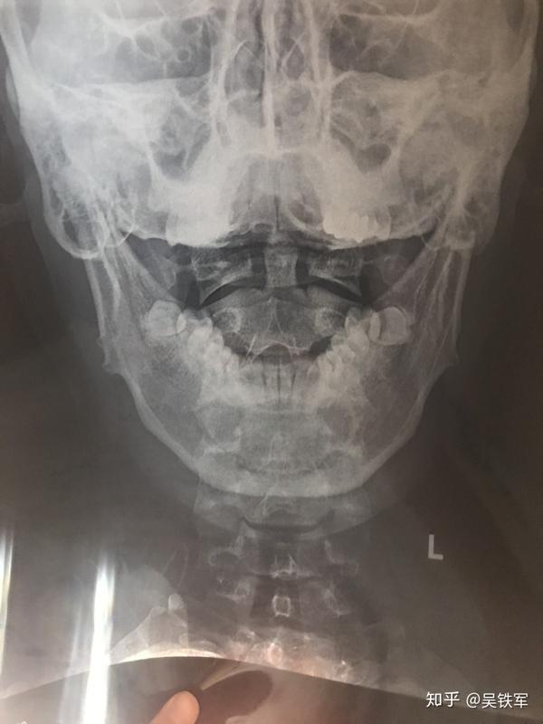这是一张患者的x光片,这是个张口位颈椎片,用来观察枕骨,寰椎和枢椎.
