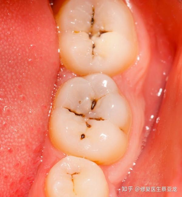 1,刚刚开始蛀牙: 蛀牙初期是发生的牙釉质,感觉不到疼痛,而且牙齿