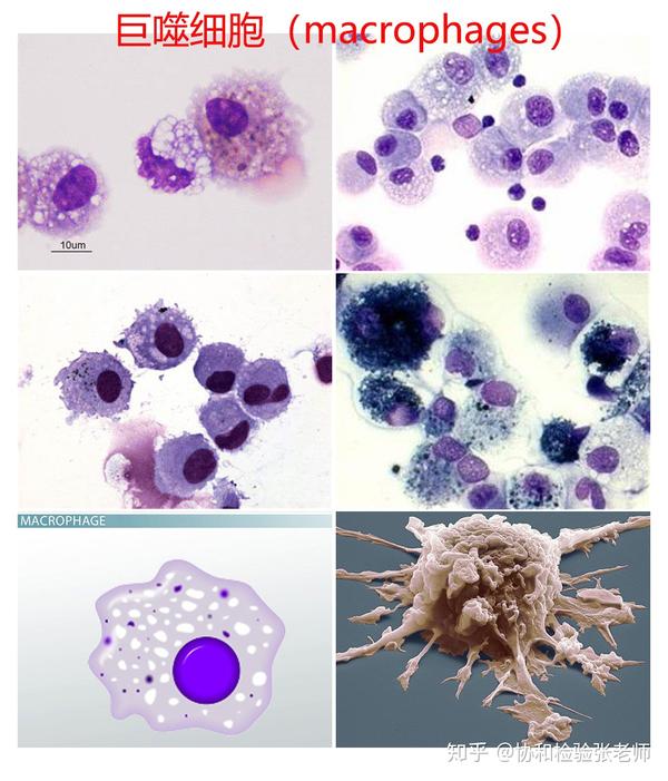 还可以见到巨噬细胞(图4),他是单核细胞进入肺组织后形成的