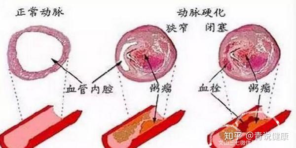 动脉硬化,粥样硬化,斑块有何不同,应如何调理!