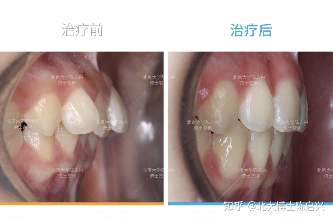 "深覆盖 牙不齐 下巴短"颜值大升级案例