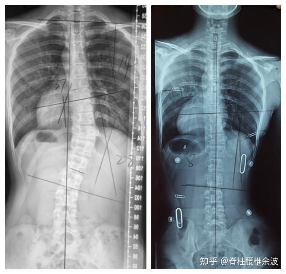 60度以下的脊柱侧弯保守有救了