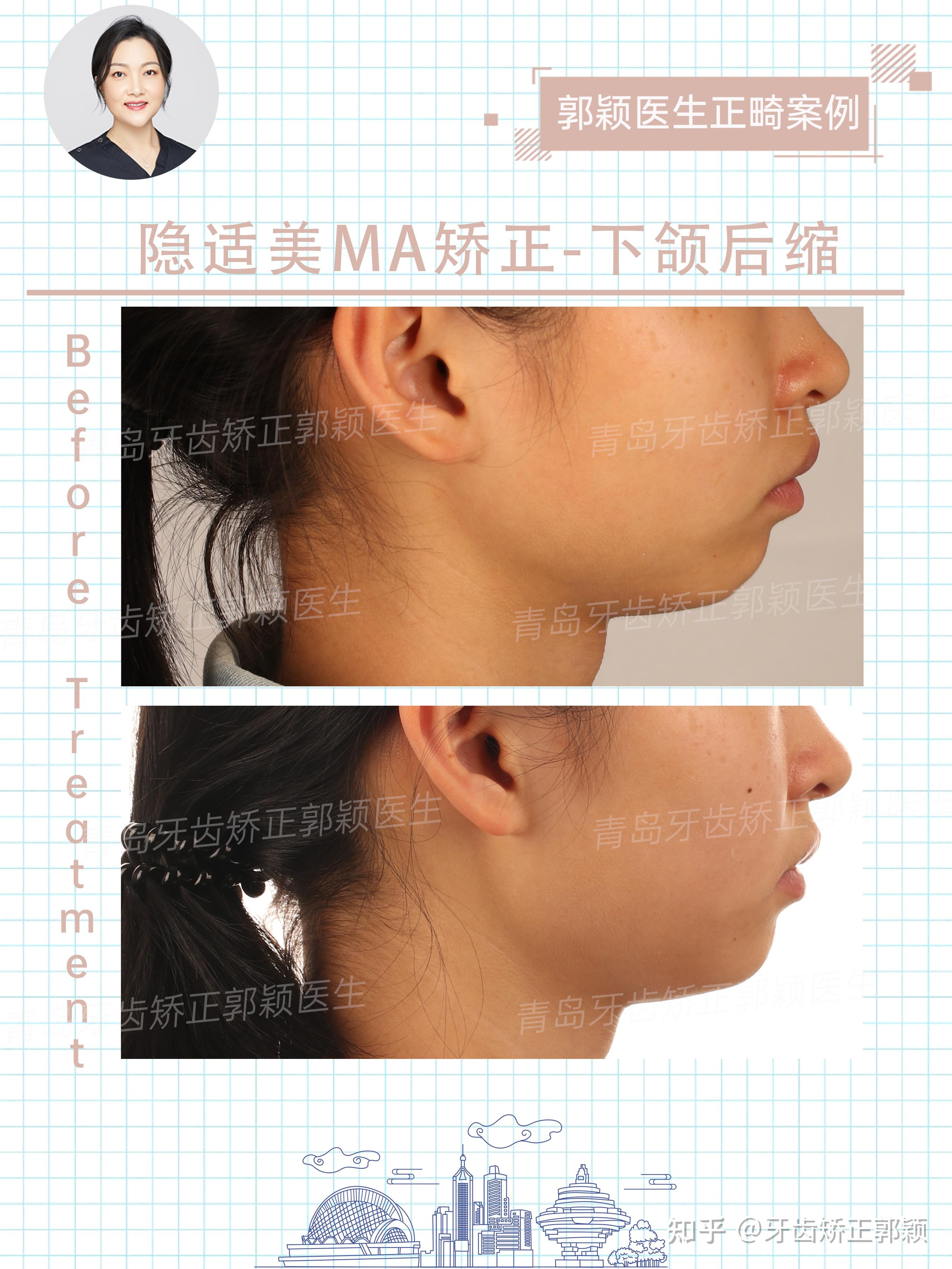 青岛牙齿矫正下颌后缩早期矫正案例