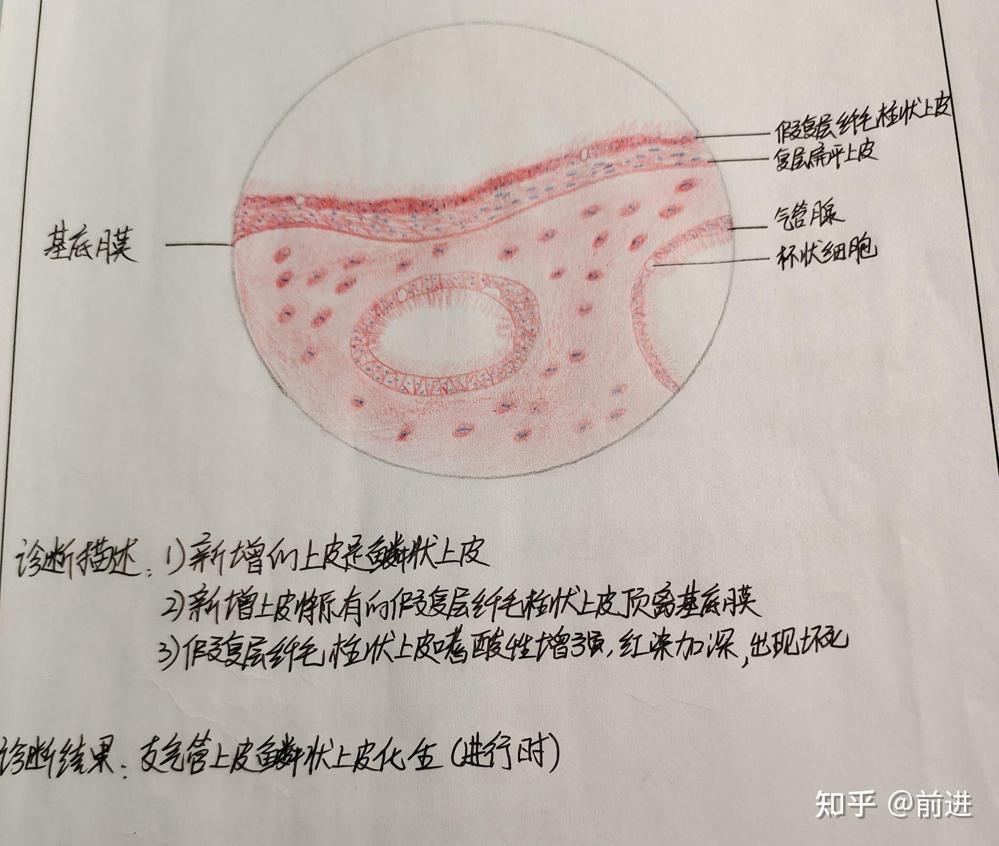 病理红蓝铅笔手绘图