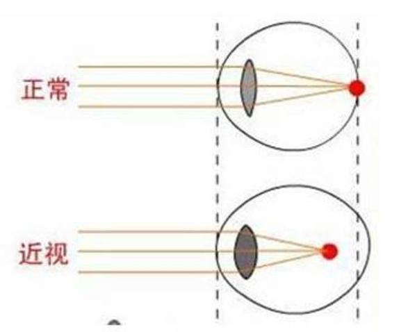 激光矫正近视眼原理是什么?是否有副作用?