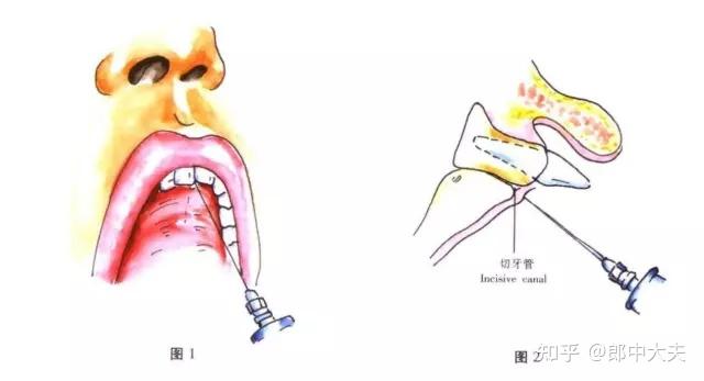 口腔医学颌面外科常用麻醉方法图谱