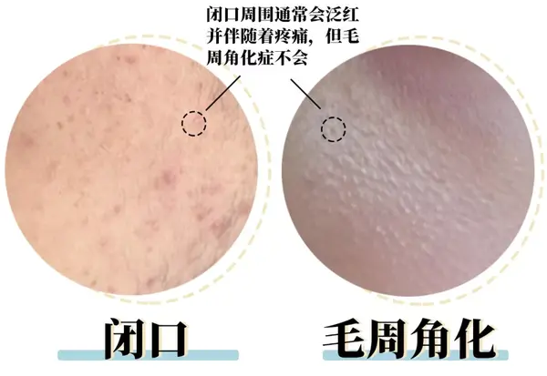 夏季,鸡皮肤怎么消除最有效 很正经的去鸡皮肤方法分享出来