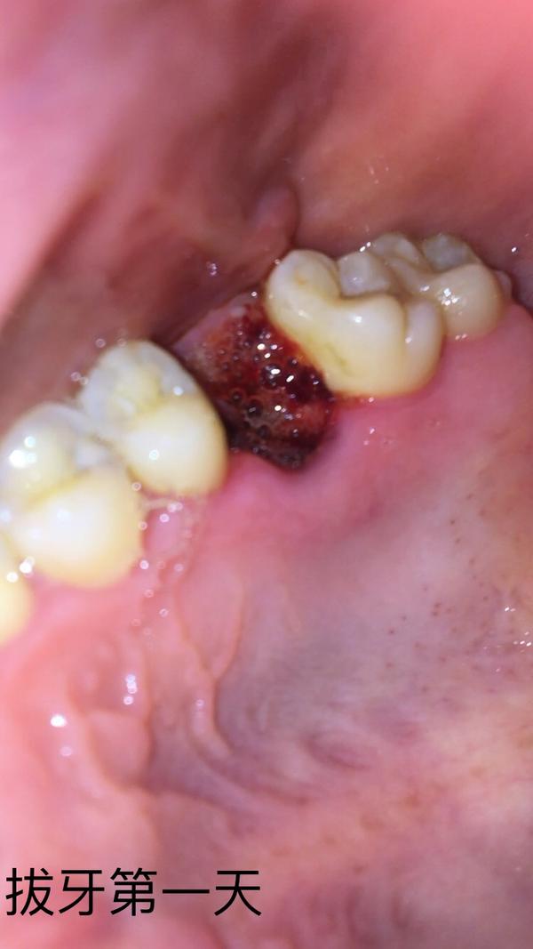 拔牙全程(多图慎点!)恢复期全过程