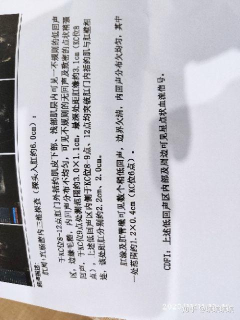 记录20201203肛周脓肿手术