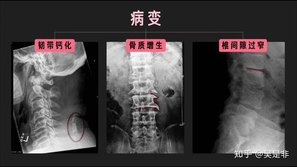 腰椎韧带钙化:也是只会觉得腰部肌肉特别紧张,弯腰前屈难,侧边拉伸也