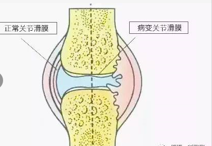 你知道膝关节滑膜炎是怎么回事吗