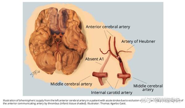部,内囊前肢等梗死灶,提示双侧heubner回返动脉由左侧大脑前动脉供血