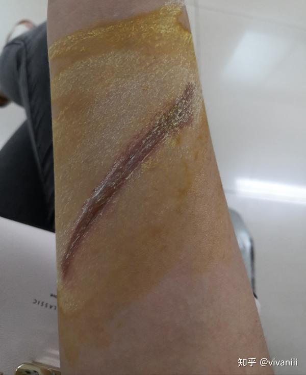 烫伤出了水泡怎么办