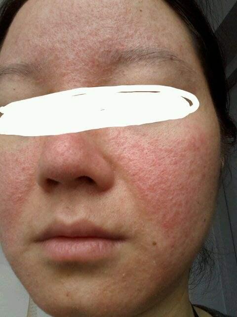 激素脸,为什么又出现疹子,脱皮,红痒?
