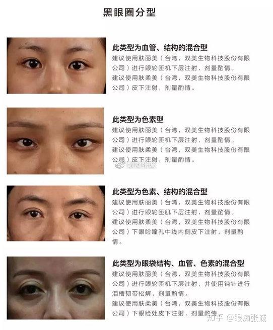 用大白话说, 结构型黑眼圈是指眼周因先天泪槽或后天皮肤老化出现眼袋