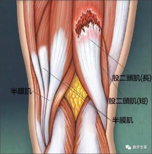 膝关节百科(第二讲):常见损伤介绍Ⅰ(肌肉拉伤,髌骨外翻,髌骨软化症)