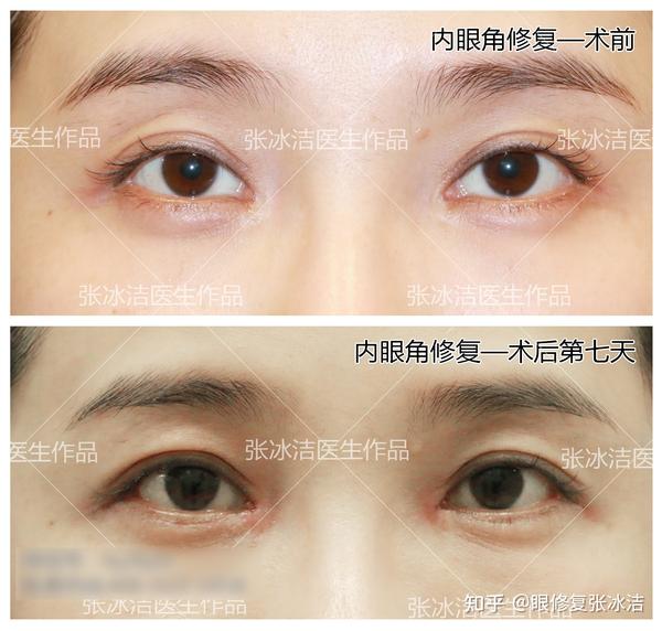 张冰洁修复内眼角开的太大丨内眼角开的太大的危害及修复方案解析