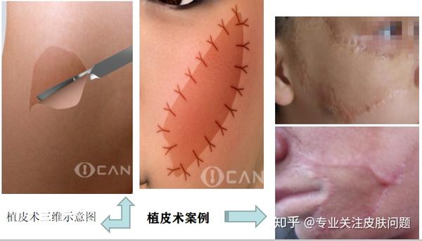 皮肤扩张术 是植皮术的替代技术,最终也会留下明显的手醯刀疤.