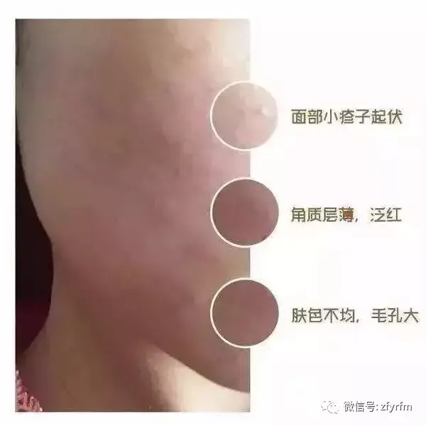 带你重新认识激素脸——06:自测激素脸严重程度