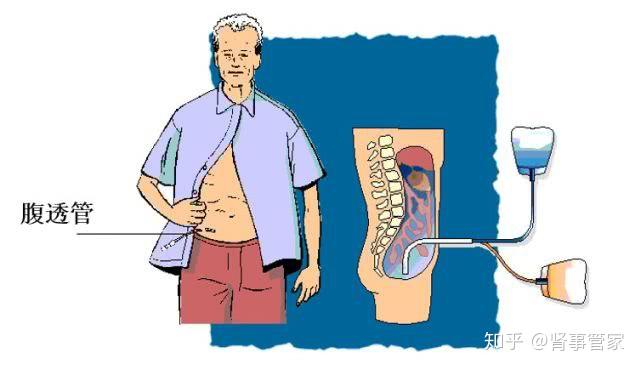 腹膜透析是指通过手术将一根腹膜透析导管植入腹腔,每日定时通过导管
