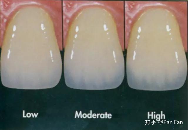 从左到右牙釉质有明显的区别,最右就是牙釉质偏透明的状况