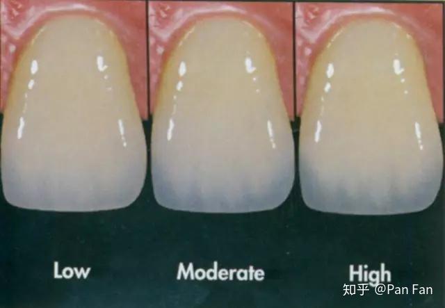 有的姑娘 牙釉质很 透明,看到牙齿黄黄的,其实就是牙本质的黄色,这种