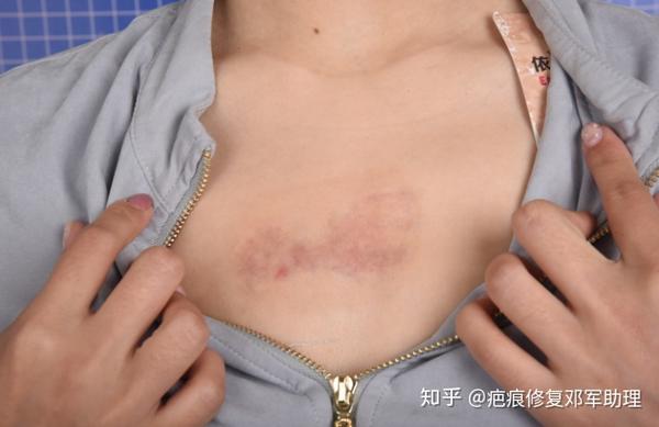 胸口疤痕疙瘩切除记录
