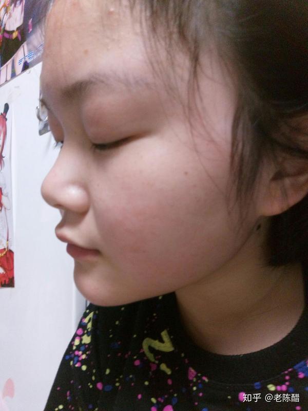 上嘴唇上翘,上翻怎么办?侧面看起来简直丑哭我!