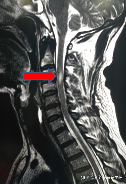磁共振提示颈3-4水平脊髓 损伤,颈椎管狭窄