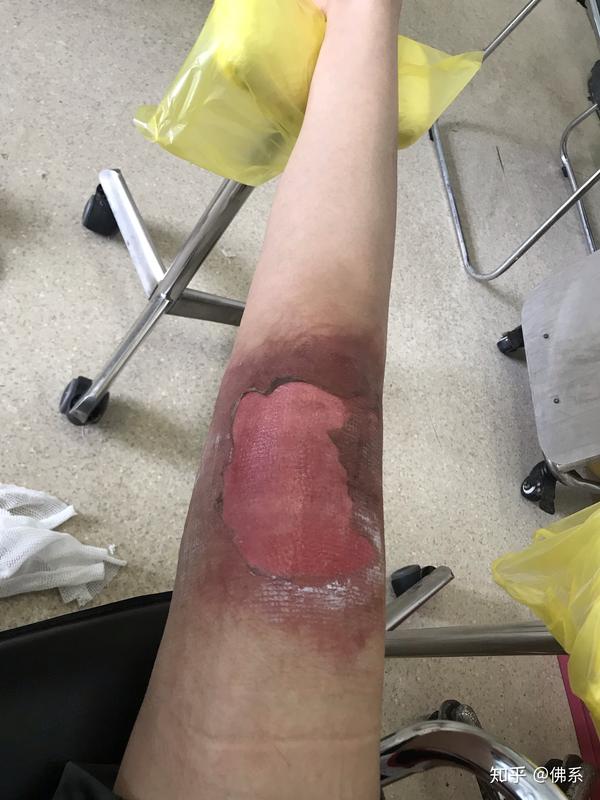 大面积烫伤记录,内有照片恐引起不适