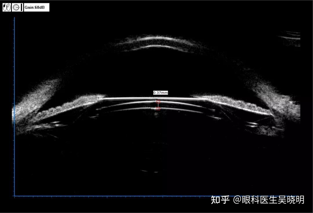 ubm拱高如果过低,icl后表面与自身晶状体距离太近,会可能影响晶状体的