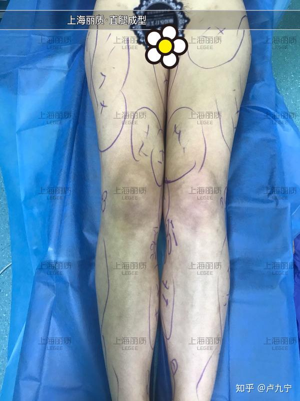 这是入院照片 大腿内侧凹凸不平 膝盖内侧缝隙过大 腿部线条不优美