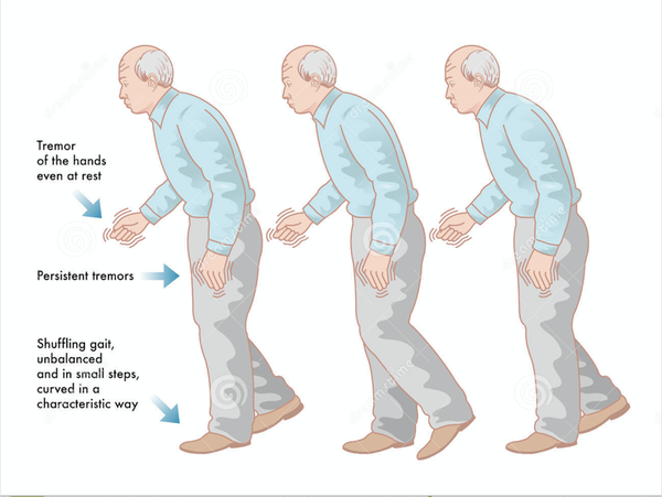 帕金森病症状  图片来源:google