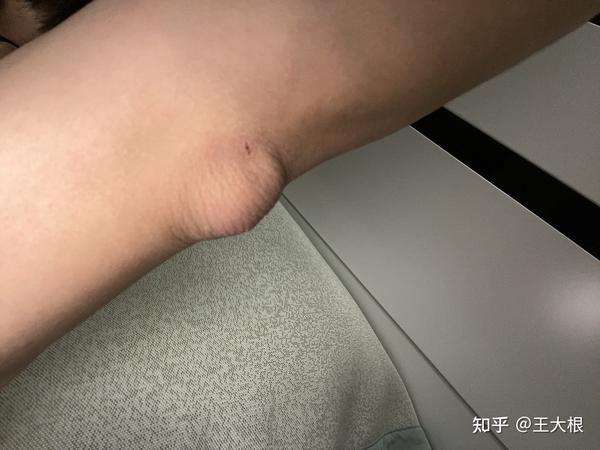 肘关节应该完全没肉,摸上去就是骨头,这硬生生给我整了一个大包突出来