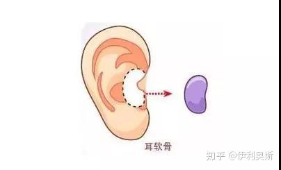 肋软骨隆鼻和耳软骨隆鼻哪个好?