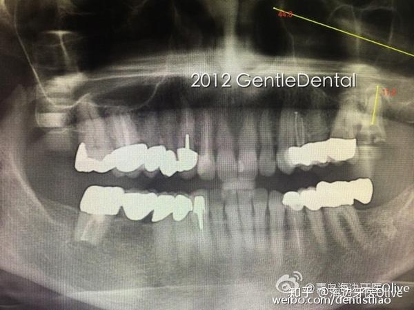 浅谈牙颈部缺损——关于楔状缺损与酸蚀症